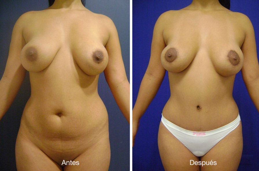 abdominoplastia-drmeneses-1