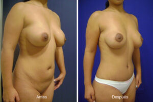 abdominoplastia-drmeneses-2