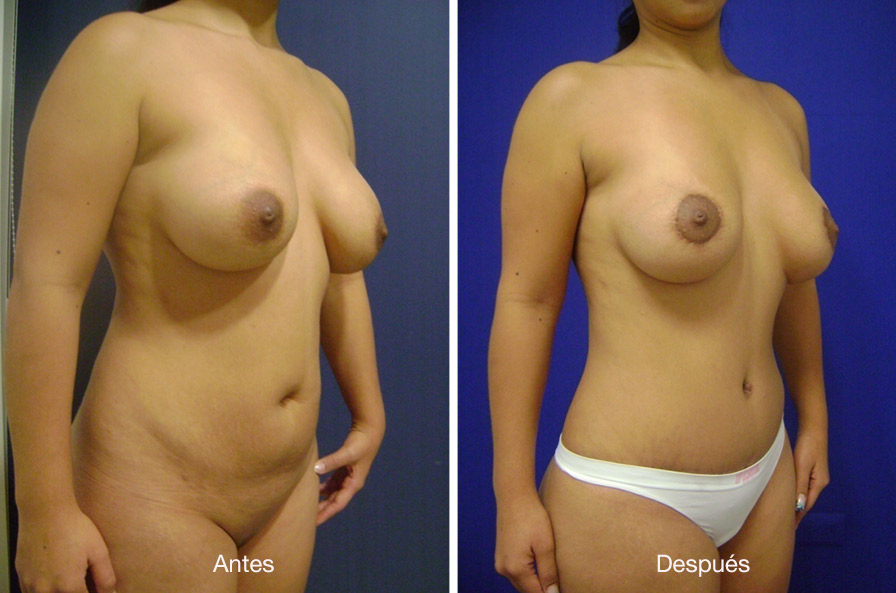 abdominoplastia-drmeneses-2
