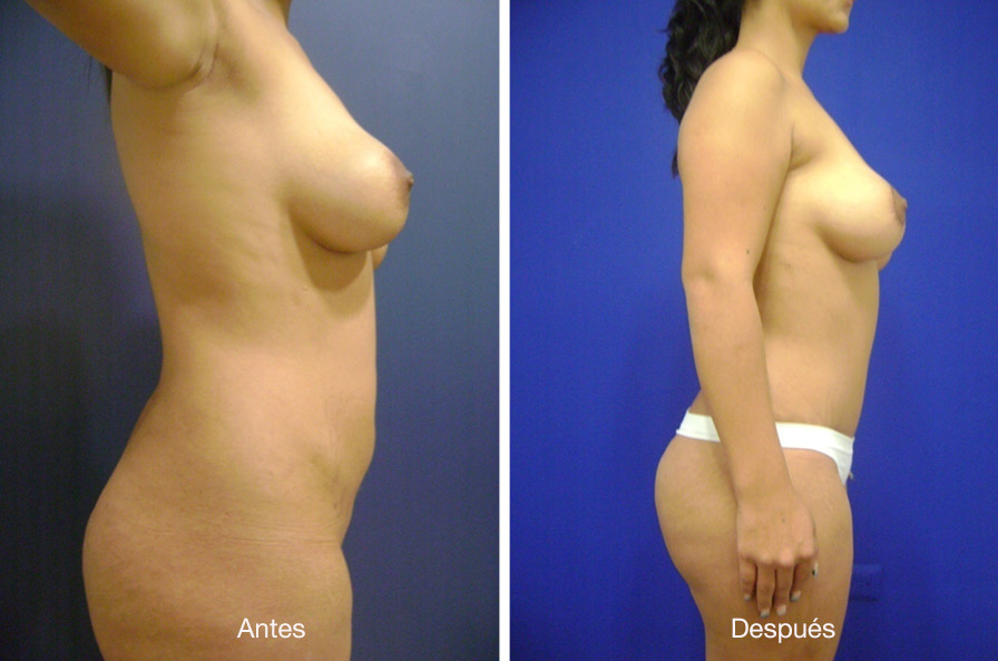 abdominoplastia-drmeneses-3