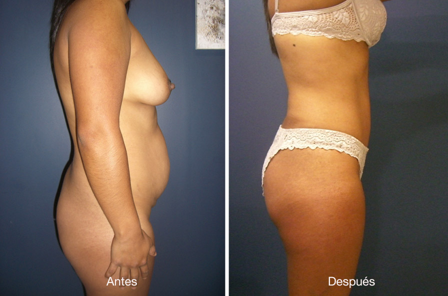 abdominoplastia-drmeneses-4