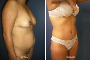 abdominoplastia-drmeneses-5