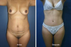 abdominoplastia-drmeneses-6
