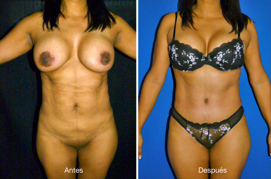 abdominoplastia_CASO_5.2