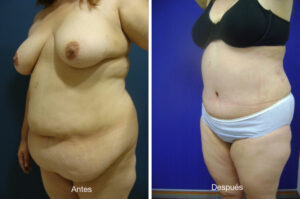 abdominoplastia_caso_10