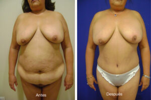 abdominoplastia_caso_11