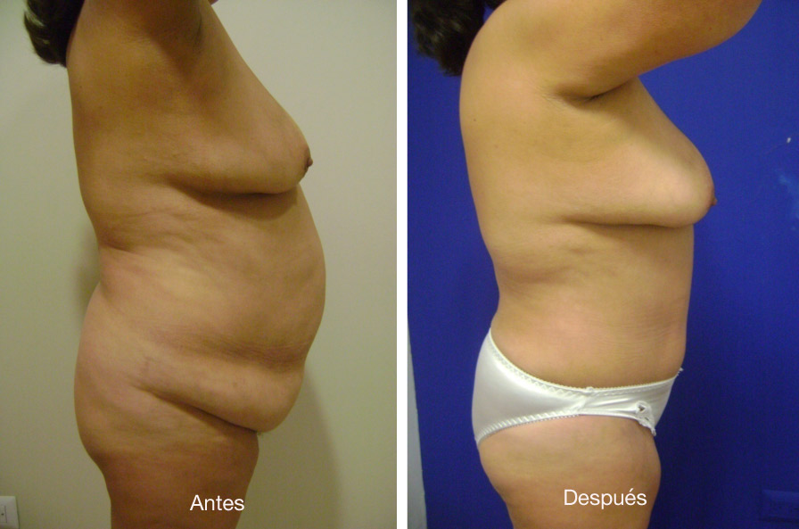 abdominoplastia_caso_12