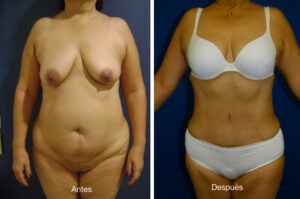 abdominoplastia_caso_13