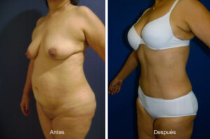 abdominoplastia_caso_14