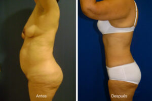 abdominoplastia_caso_15