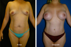 abdominoplastia_caso_16