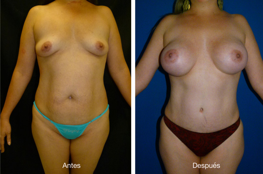 abdominoplastia_caso_16
