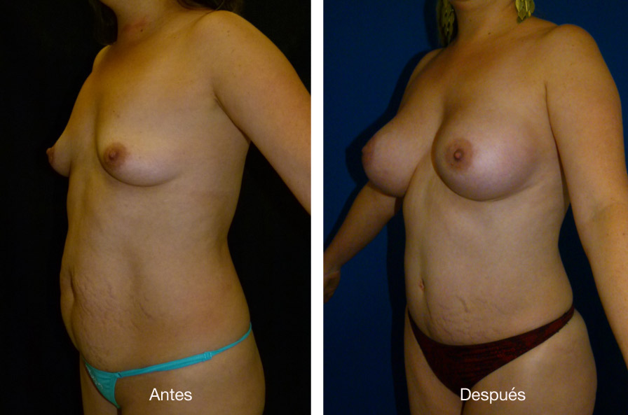 abdominoplastia_caso_17