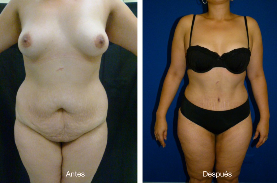 abdominoplastia_caso_19