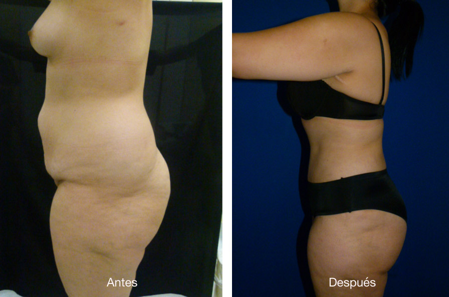 abdominoplastia_caso_19_1
