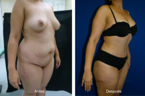 abdominoplastia_caso_19_2