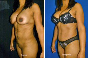 abdominoplastia_caso_5