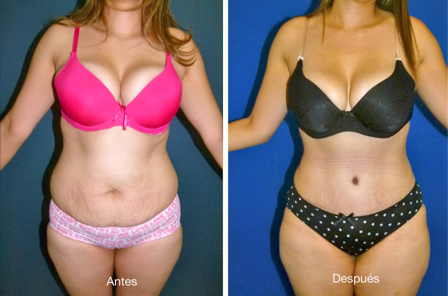 abdominoplastia_caso_6
