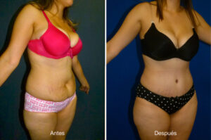 abdominoplastia_caso_7