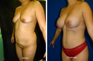 abdominoplastia_caso_8-1
