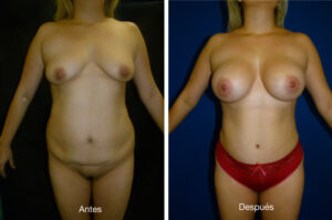 abdominoplastia_caso_8