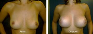 aumento-mamario-1