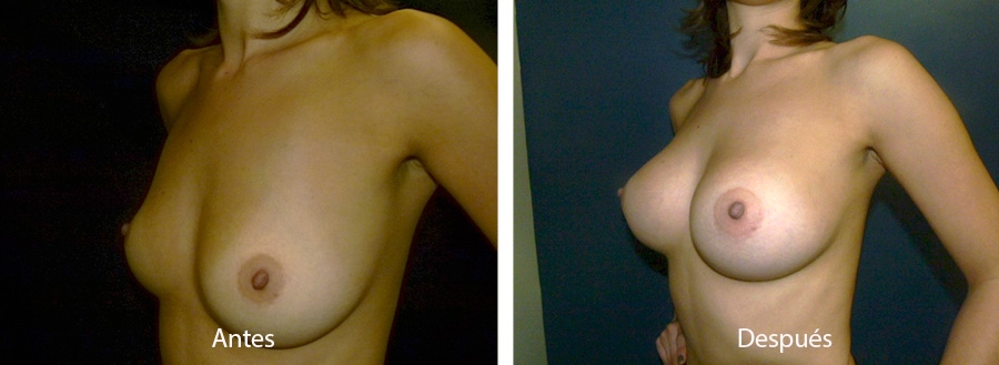 aumento-mamario-3