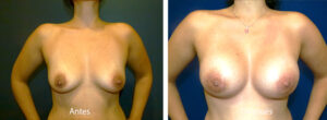 aumento-mamario-4