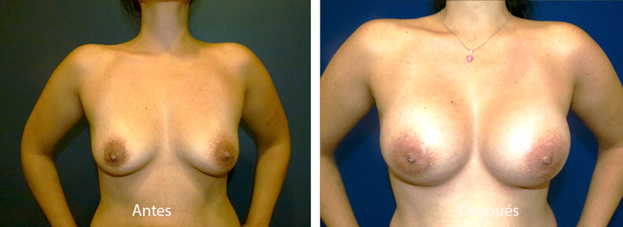 aumento-mamario-4
