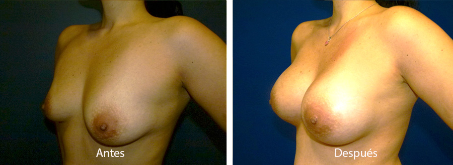 aumento-mamario-5