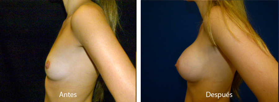 aumento_mamario_caso10