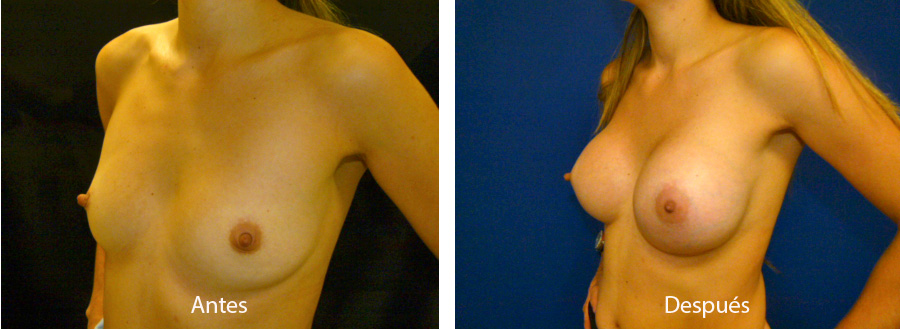 aumento_mamario_caso11