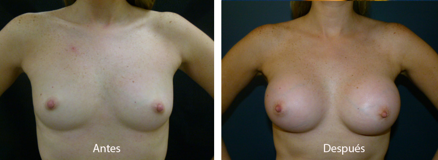 aumento_mamario_caso12