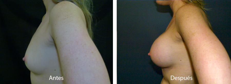 aumento_mamario_caso14