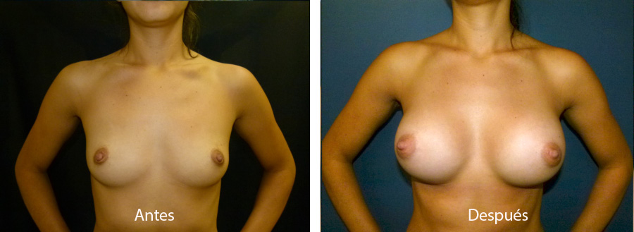 aumento_mamario_caso15