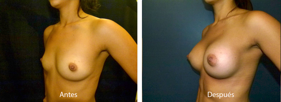 aumento_mamario_caso16