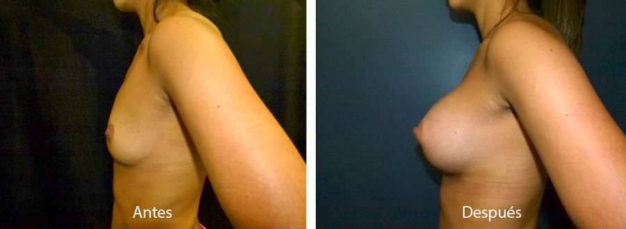 aumento_mamario_caso17