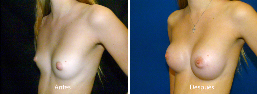 aumento_mamario_caso2