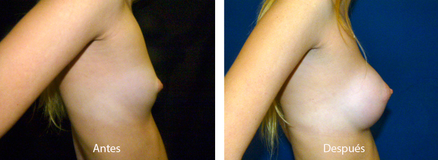 aumento_mamario_caso3