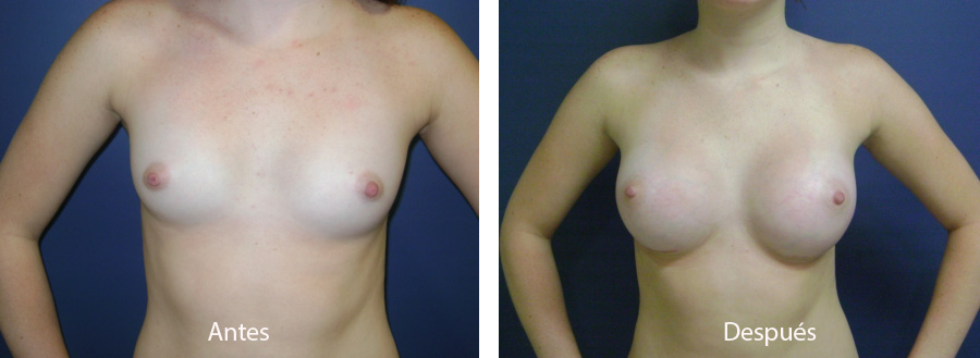 aumento_mamario_caso6