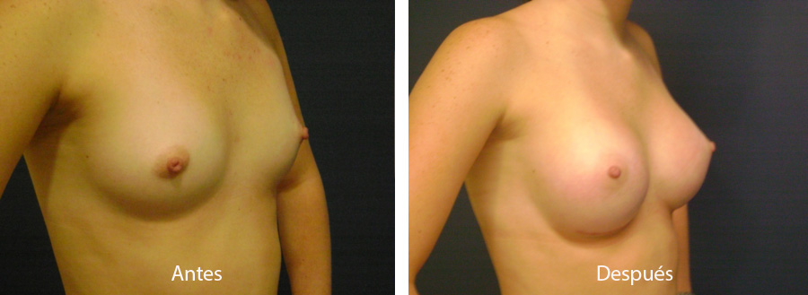aumento_mamario_caso7