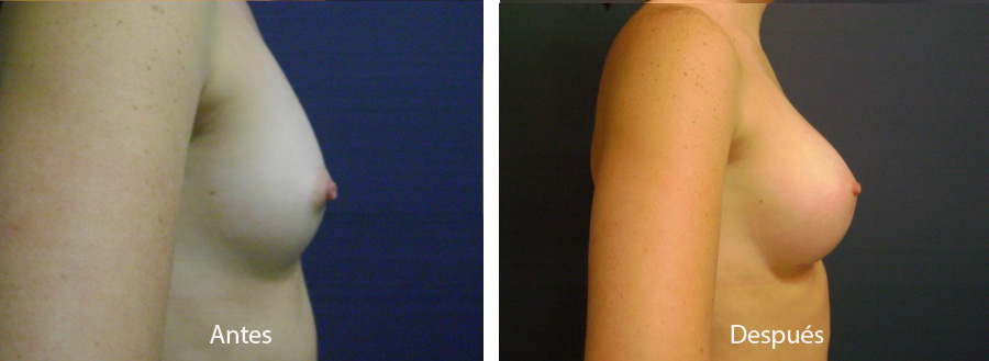 aumento_mamario_caso8