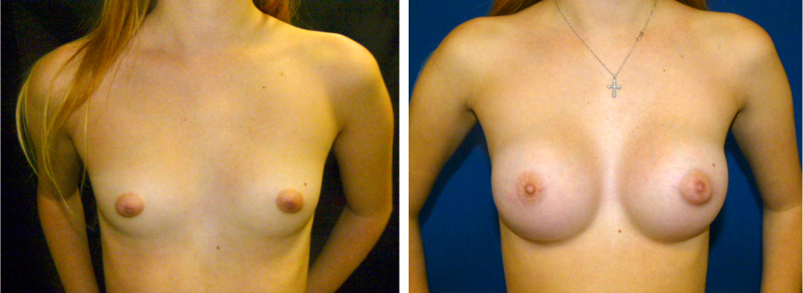 aumento_mamario_caso_1