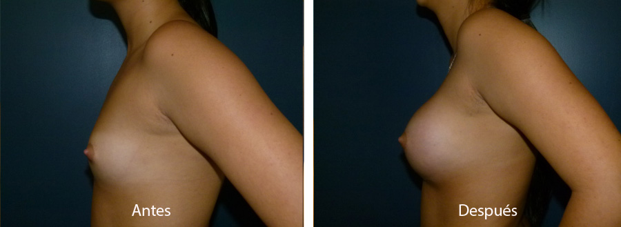 aumento_mamario_caso_22