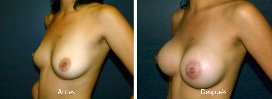 aumento_mamario_caso_26