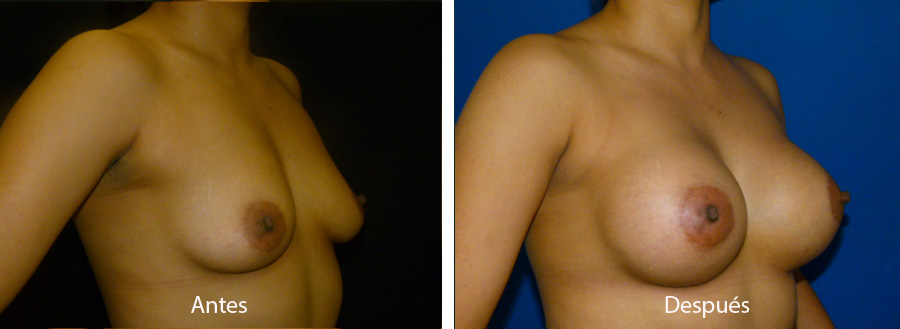 aumento_mamario_caso_28