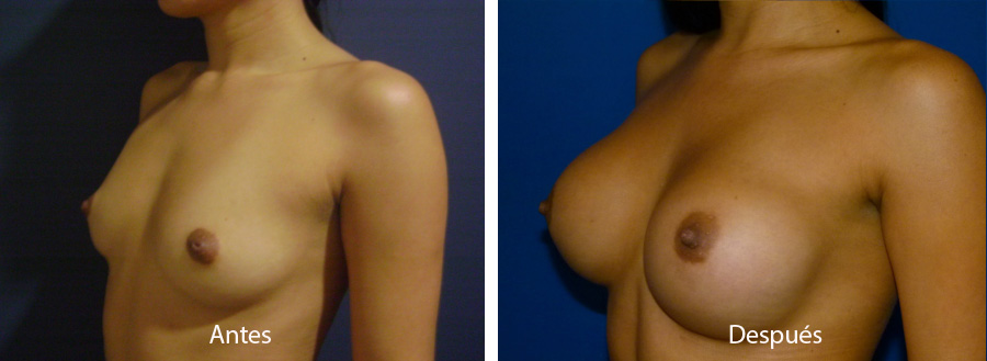 aumento_mamario_caso_29