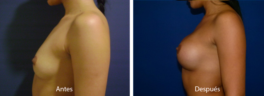 aumento_mamario_caso_30