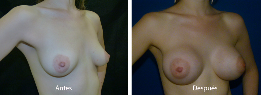 aumento_mamario_caso_33