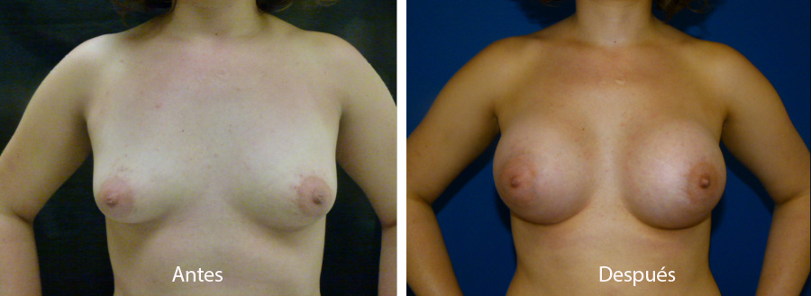 aumento_mamario_caso_35